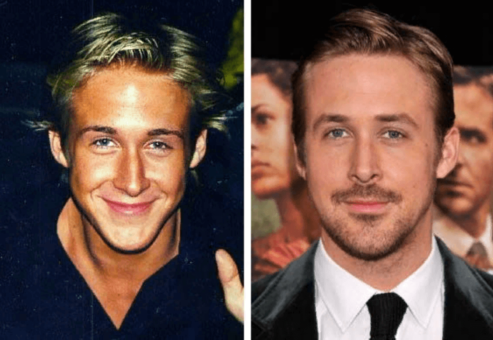 Ryan Gosling Botox