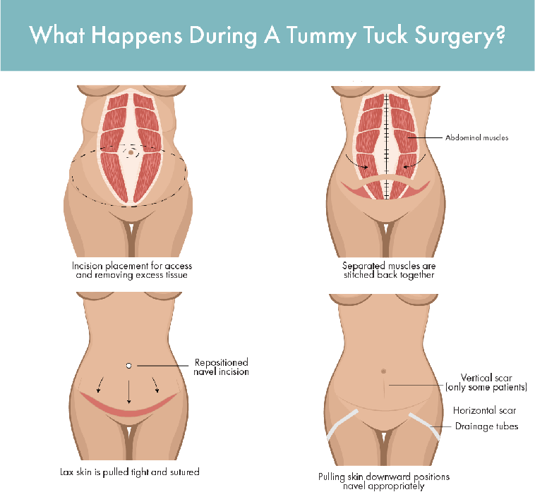 What Happens During A Tummy Tuck Surgery?