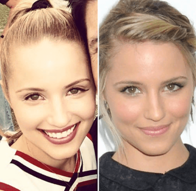 Dianna Agron Lip Injection