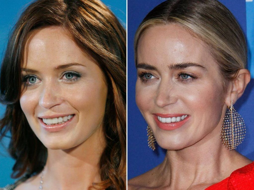 Emily Blunt Plastic Surgery: Before & After | PlasticSurgeryInsights.com