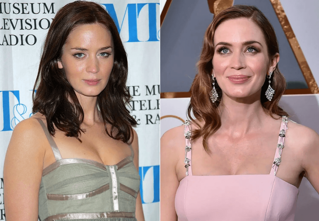 Emily Blunt Lip Injections