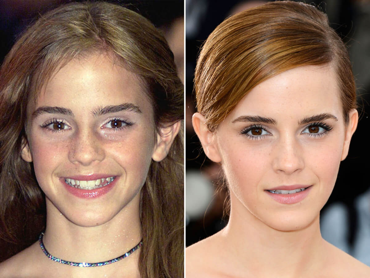 Emma Watson Before and After