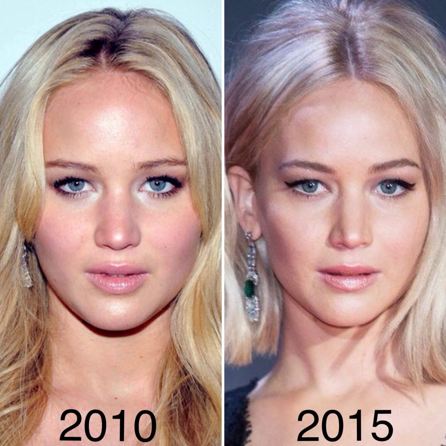 Jennifer Lawrence Plastic Surgery Before & After