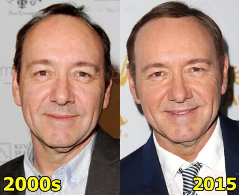 Kevin Spacey Plastic Surgery