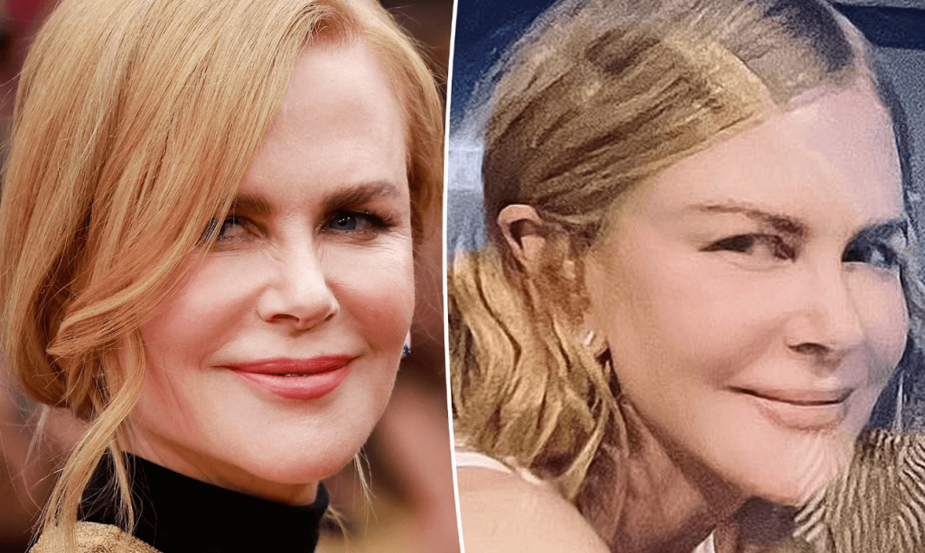 Nicole Kidman's Plastic Surgery: Before And After ...