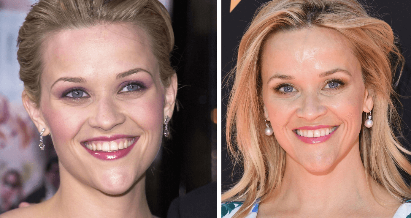 Reese Witherspoon Skin Treatments