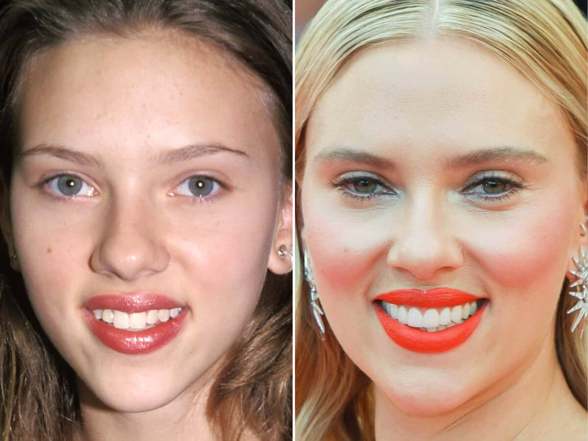 Scarlett Johansson Lip Injection