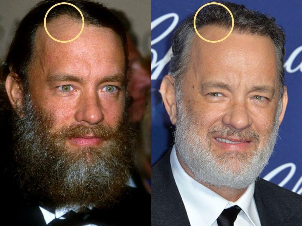 Tom Hanks Hair Transplant