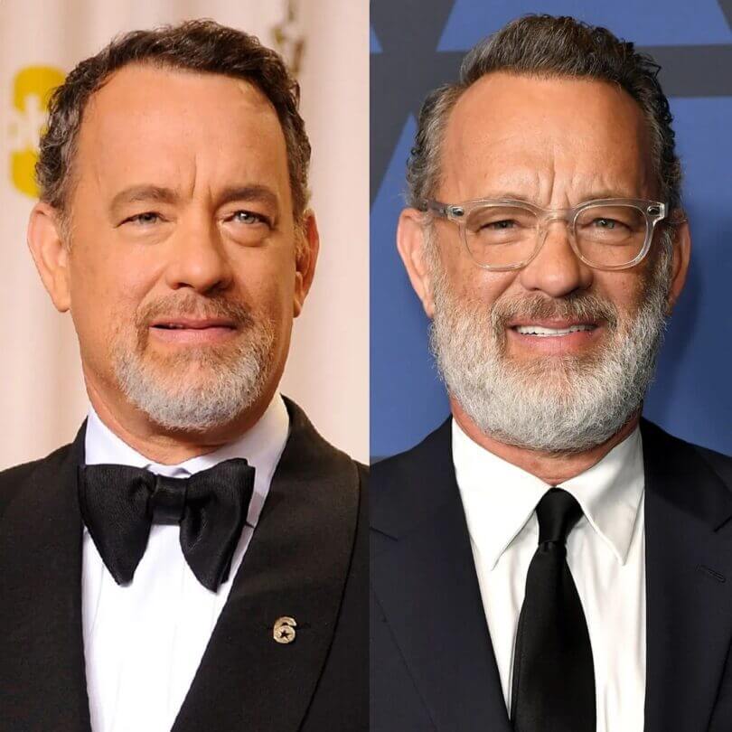 Tom Hanks Skin Treatments