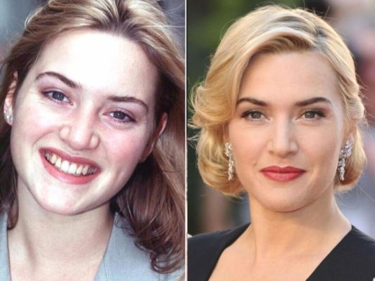 Kate Winslet Plastic Surgery: Before & After | PlasticSurgeryInsights.com