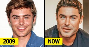 Zac Efron Plastic Surgery: Analyzing the Transformation ...