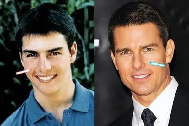 Tom Cruise Nose Job