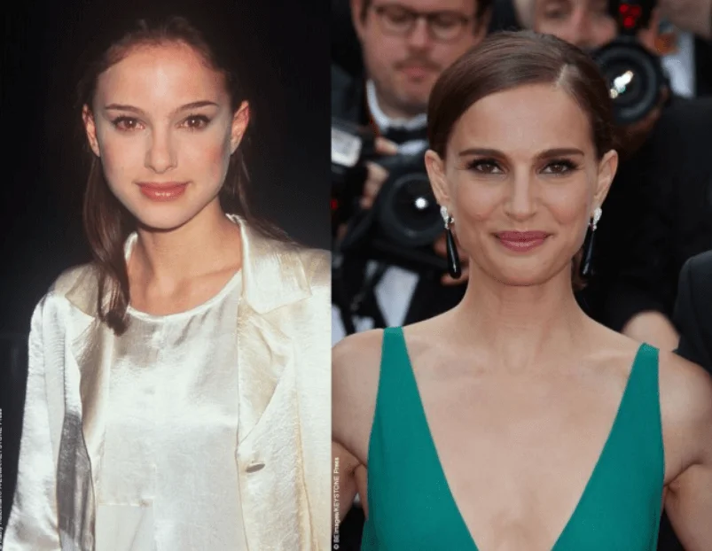 Natalie Portman Eyelid Surgery