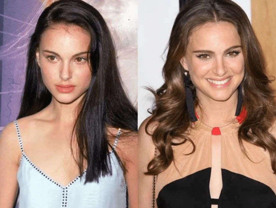 Natalie Portman Face Fillers