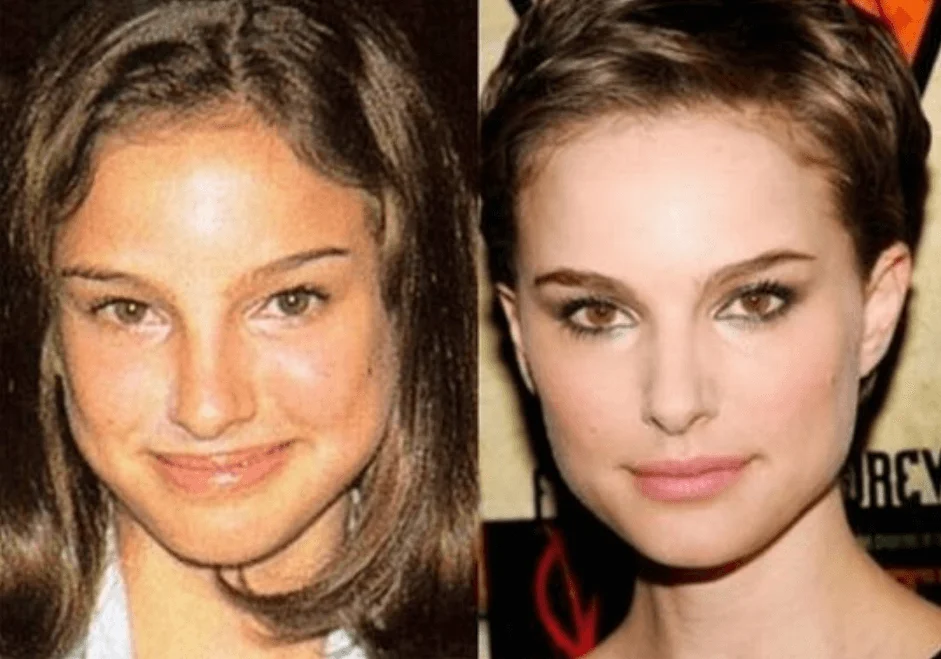 Natalie Portman Nose Job