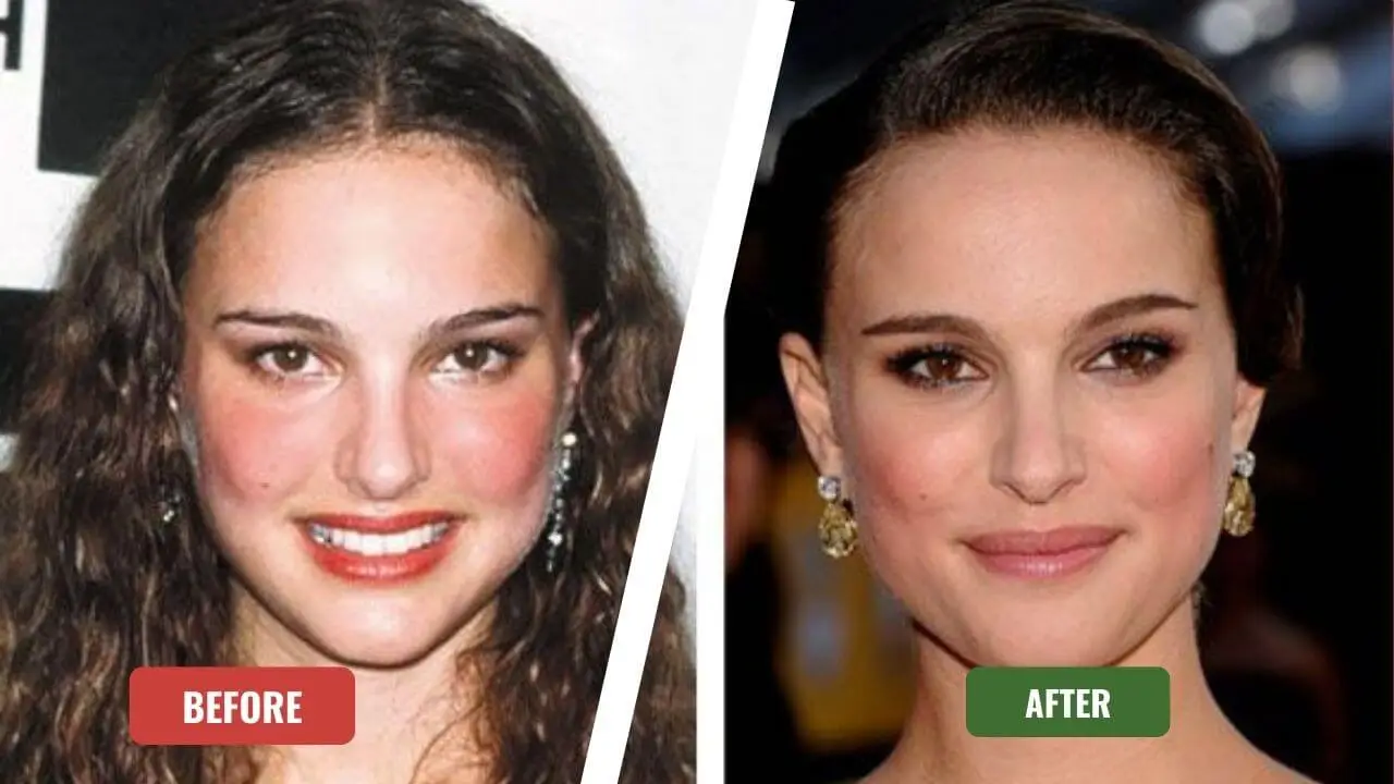 Natalie Portman Plastic Surgery